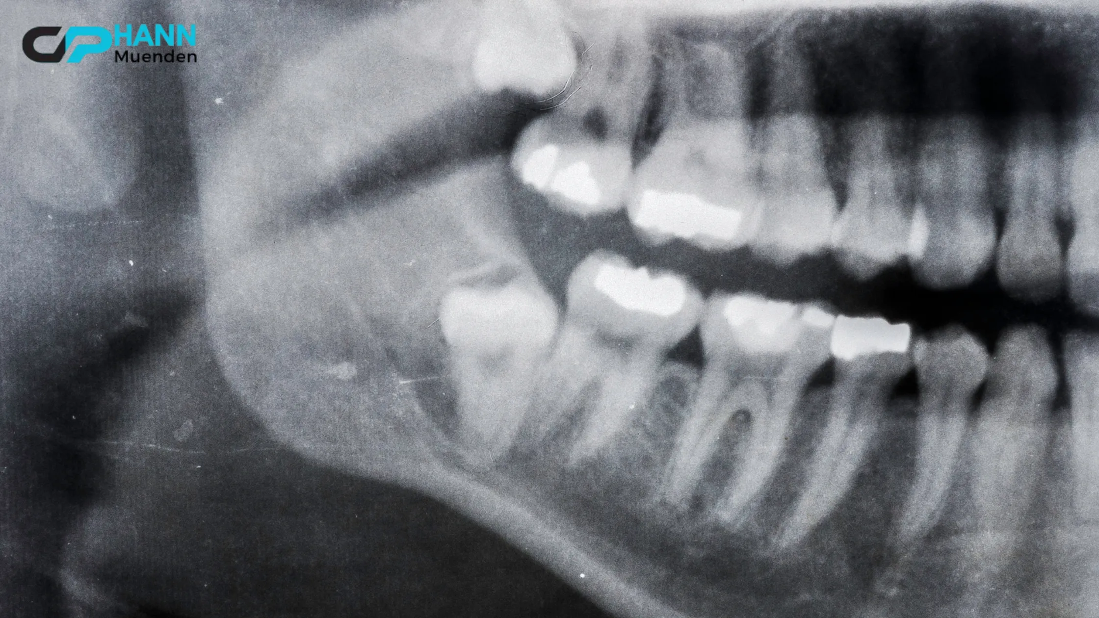 An X-ray of a patient's jaw showing impacted wisdom teeth. Can you keep your wisdom teeth if they are positioned this way? This image helps illustrate dental concerns related to wisdom teeth.