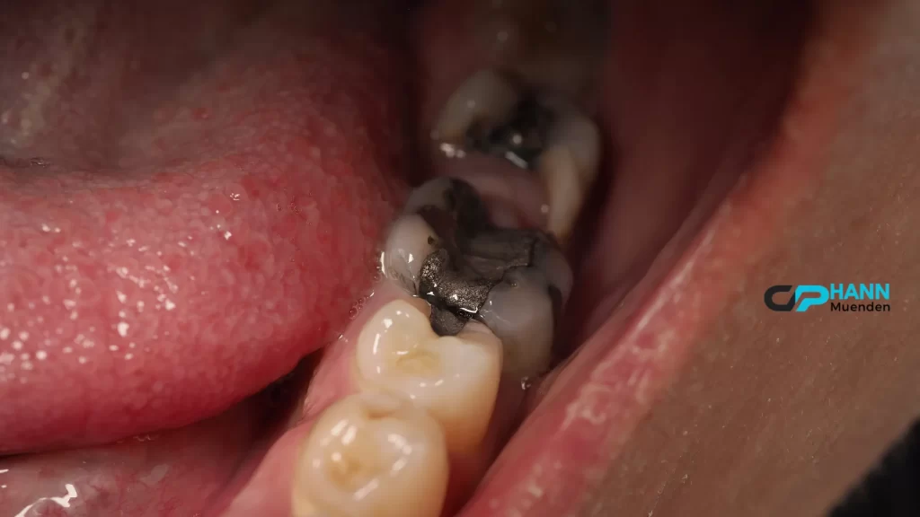 A decaying tooth with a visible filling demonstrates how tooth infections can escalate without proper dental care. How long until a tooth infection kills you?