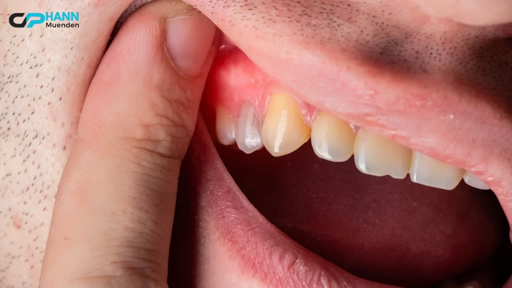 A tooth infection with visible swelling and redness highlights the risk of complications if untreated. How long until a tooth infection kills you?